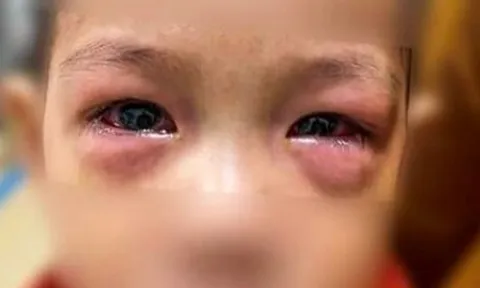 Dịch đau mắt đỏ gia tăng và những điều cần lưu ý