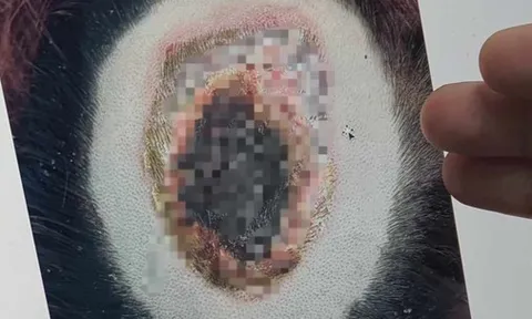 Tẩy tóc khiến cả mảng da đầu cô gái trẻ loét, chảy mủ