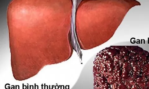 Ung thư gan có số ca tử vong dẫn đầu