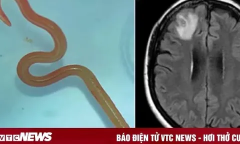 Gắp con giun còn sống ngoe nguẩy trong não người phụ nữ