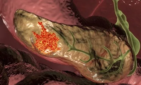 1 dấu hiệu sớm cảnh báo ung thư tuyến tụy: 75% bệnh nhân có triệu chứng này