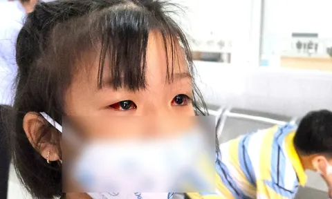 Bệnh viện Nhi đồng 2: Hàng chục ca đau mắt đỏ đến khám mỗi ngày