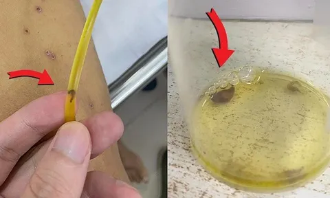 Hy hữu: Sán theo ống dẫn lưu đường mật ra ngoài, 'thủ phạm' đến từ món nhiều người thích