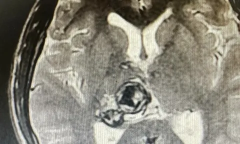 Nam sinh viên 20 tuổi phát hiện khối u não sau khi thấy đau đầu, chóng mặt