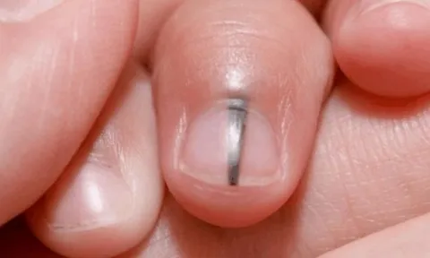 6 dấu hiệu cảnh báo trước khi ung thư ập đến, ít ai chú ý tới