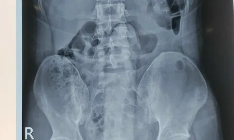 Nam thanh niên mắc kẹt đồ chơi tình dục trong... trực tràng