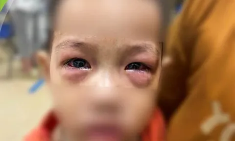 Gia tăng bệnh nhân đau mắt đỏ, bác sĩ nói không cần “săn” thuốc “xịn"