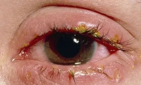 Tp.HCM: Ngành y tế đã xác định tác nhân gây ra bệnh đau mắt đỏ