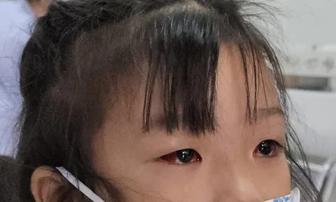 Đau mắt đỏ có lây qua đường uống?