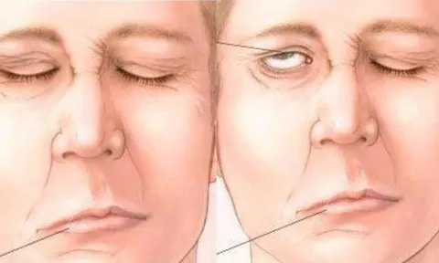 Trúng gió và đột quỵ não thường bị nhầm lẫn, phân biệt ra sao để có cách xử trí đúng?