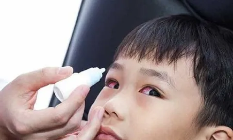 Sở Y tế TPHCM lên tiếng về thông tin bệnh đau mắt đỏ lây qua nước uống