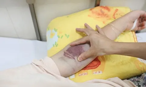 Hà Nội: Số bệnh nhân sốt xuất huyết tăng 4 lần so với cùng kỳ 2022, ghi nhận thêm 1 ca tử vong