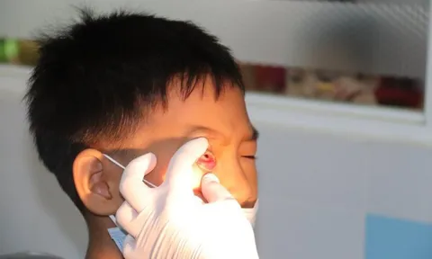 Đau mắt đỏ xu hướng gia tăng, Bộ Y tế ra 5 biện pháp phòng chống