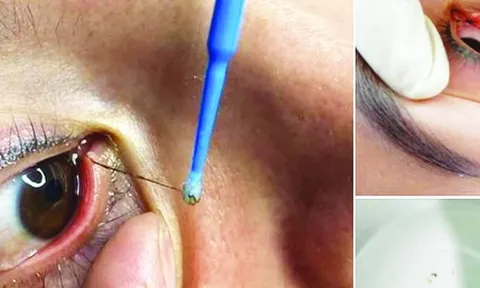 Bác sĩ nói gì về dịch vụ “bắt sâu mắt" đang nở rộ?