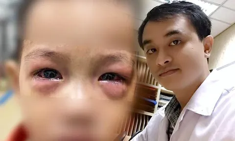 Bệnh đau mắt đỏ lây lan cả nước, bác sĩ đưa những cách hạn chế nhiễm bệnh trong giai đoạn này