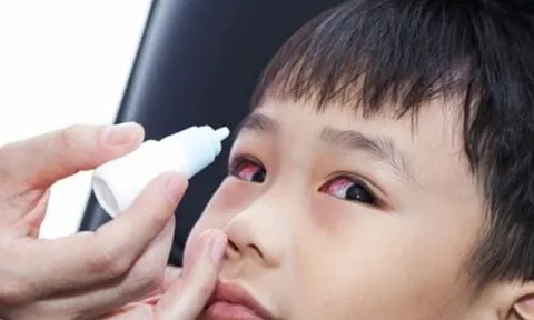 6.000 ca đau mắt đỏ, chủ yếu là trẻ em ở Quảng Bình