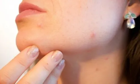 Bị viêm màng não vì việc tưởng vô hại nhiều người làm với khuôn mặt