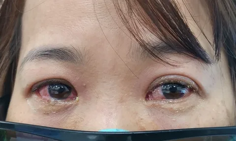 Người bệnh đau mắt đỏ cần làm gì và những lưu ý khi sử dụng thuốc nhỏ mắt