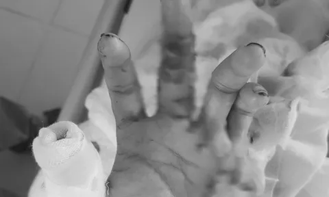 Giữ được bàn tay đứt lìa 2 ngón, nam thanh niên xúc động cảm ơn bác sĩ