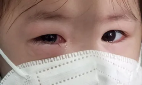 Bệnh đau mắt đỏ gia tăng, Bộ Y tế yêu cầu tăng cường giám sát