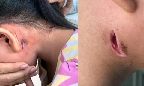 Nhiều người nhiễm vi khuẩn "ăn thịt người", Bộ Y tế ra khuyến cáo