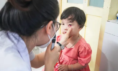 Bộ Y tế: Kiểm soát chặt chẽ giá thuốc điều trị bệnh đau mắt đỏ