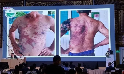 Những dấu hiệu trên da cảnh báo bệnh lý ác tính