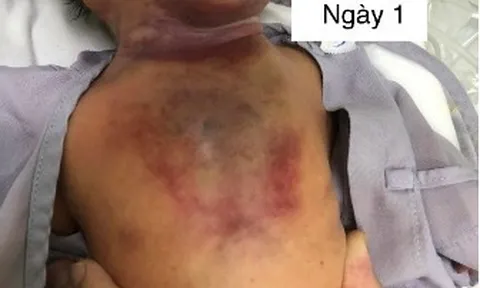 Bệnh hiếm khiến bé gái 1 ngày tuổi hẹp đường thở, suy hô hấp