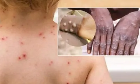 Có 8 người tại Tp.HCM theo dõi sức khỏe do tiếp xúc gần ca đậu mùa khỉ