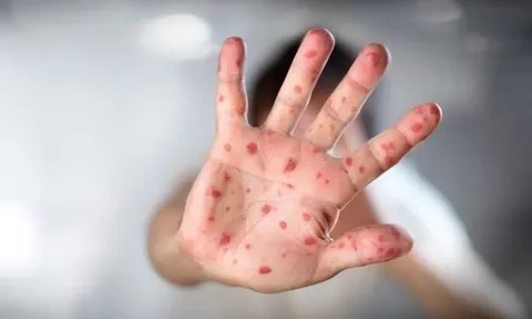 Đồng Nai ghi nhận ca bệnh đậu mùa khỉ đầu tiên