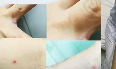 Đồng Nai phát hiện 1 ca đậu mùa khỉ, bạn gái cũng có triệu chứng mắc bệnh