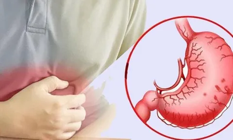 Bé trai thủng dạ dày do vi khuẩn HP, bác sĩ khuyến cáo những việc cần thay đổi trong gia đình để phòng bệnh