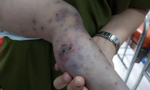 Bệnh nhi 3 tuổi tử vong vì bệnh tay chân miệng sau 15 phút nhập viện