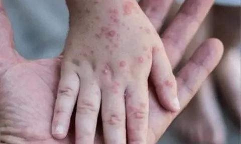 Đồng Nai: Xuất hiện ca mắc bệnh đậu mùa khỉ