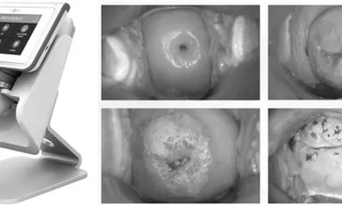 Bệnh viện sản khoa ở TP HCM dùng AI chẩn đoán sớm ung thư cổ tử cung
