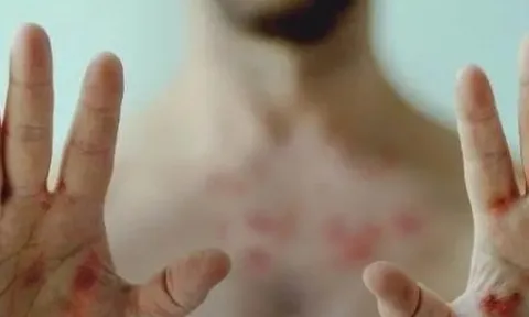 Cảnh báo sự nguy hiểm của bệnh đậu mùa khỉ