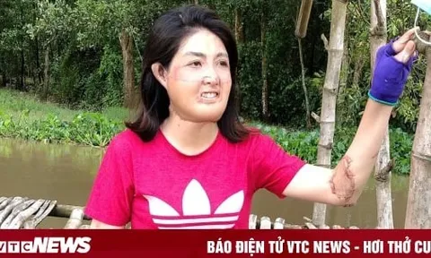 Sau 23 lần phẫu thuật, người phụ nữ từng bị chồng đổ xăng đốt hiện ra sao?