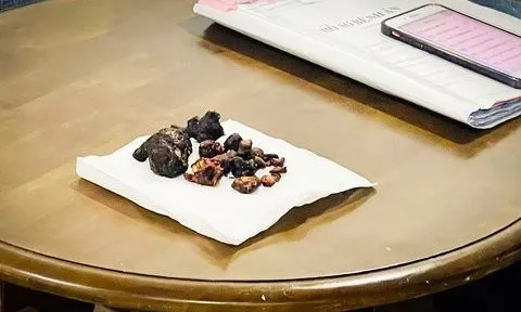 Đồng Nai: Phát hiện khối sỏi san hô lớn trong người bệnh nhân