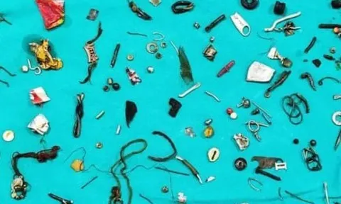 Bác sỹ sốc khi phát hiện cả 'nhà kho' gồm 60 món đồ trong bụng bệnh nhân