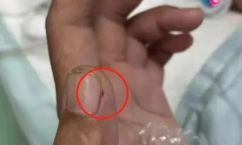 Bị viêm màng não nguy kịch vì cách sơ chế thịt lợn sai nhiều người mắc