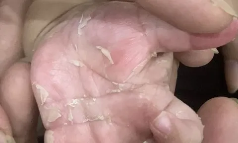 Nguyên nhân không ngờ khiến bé trai 3 tháng tuổi mắc bệnh giang mai