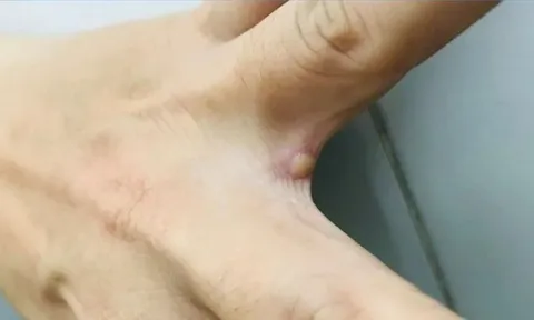 TP HCM ghi nhận ca bệnh đậu mùa khỉ ở quận Tân Bình