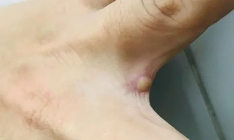 TP. Hồ Chí Minh đã có kết quả giải mã gene ca mắc đậu mùa khỉ nội địa đầu tiên