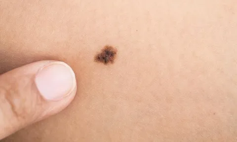 Dấu hiệu nhận biết nốt ruồi ác tính, mọi người nhất định phải biết