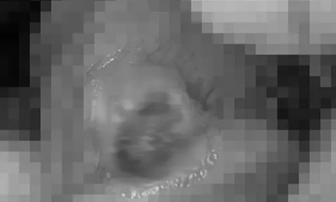 Sốt cao, tổn thương "của quý", người đàn ông mới biết bị giang mai