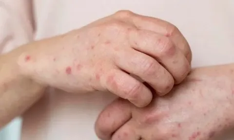 "Đậu mùa khỉ xâm nhập vào Việt Nam là khó tránh khỏi"