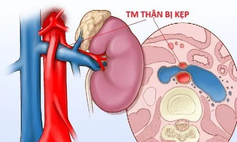 3 năm đau bụng không tìm được nguyên nhân: BS cảnh báo hội chứng gặp ở người bụng phẳng