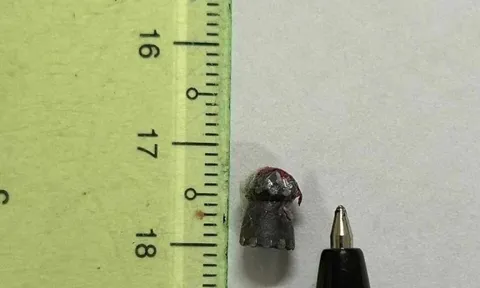 Cấp cứu người đàn ông bị "đạn lạc" xuyên ngực khi đi làm rẫy