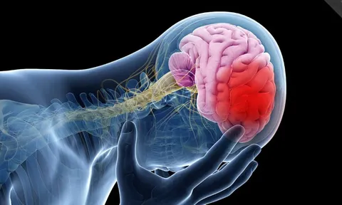 Đột quỵ sẽ tăng vọt, đặc biệt ở châu Á: Cảnh báo 4 lý do chính