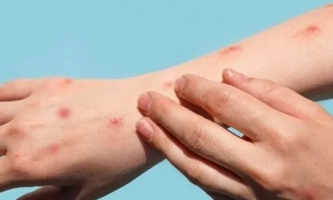 Long An ghi nhận ca đậu mùa khỉ đầu tiên